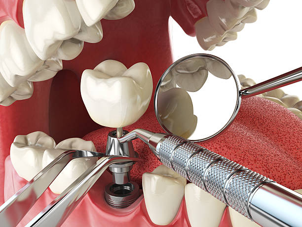 Best Emergency Dental Care for Broken or Chipped Teeth in Spencer, IN