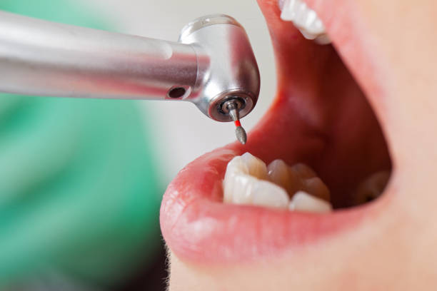 Best Emergency Wisdom Teeth Removal in Spencer, IN